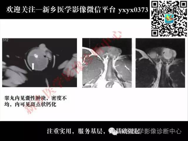 【PPT】睾丸肿瘤影像诊断