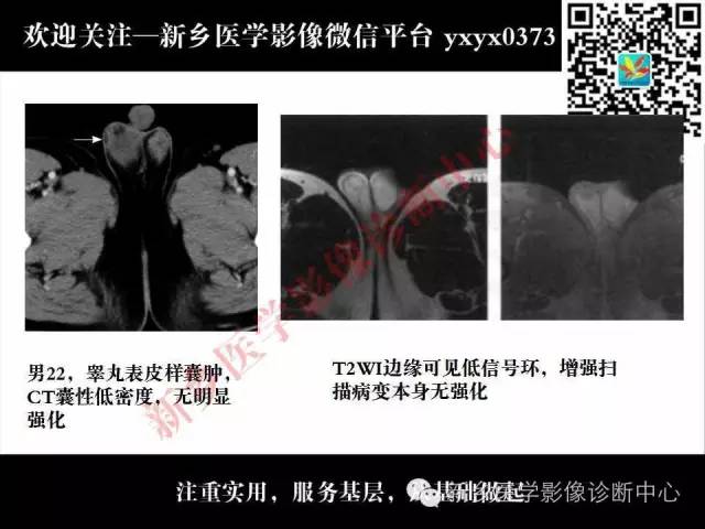 【PPT】睾丸肿瘤影像诊断