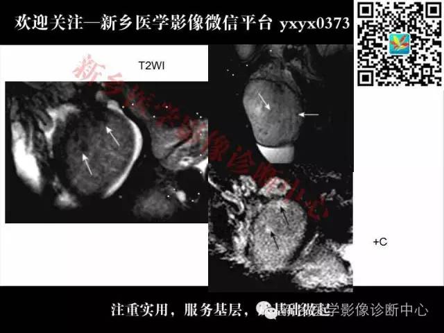 【PPT】睾丸肿瘤影像诊断