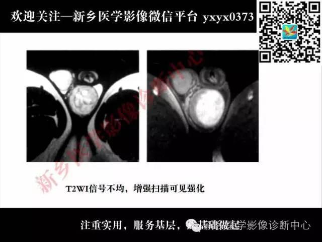 【PPT】睾丸肿瘤影像诊断