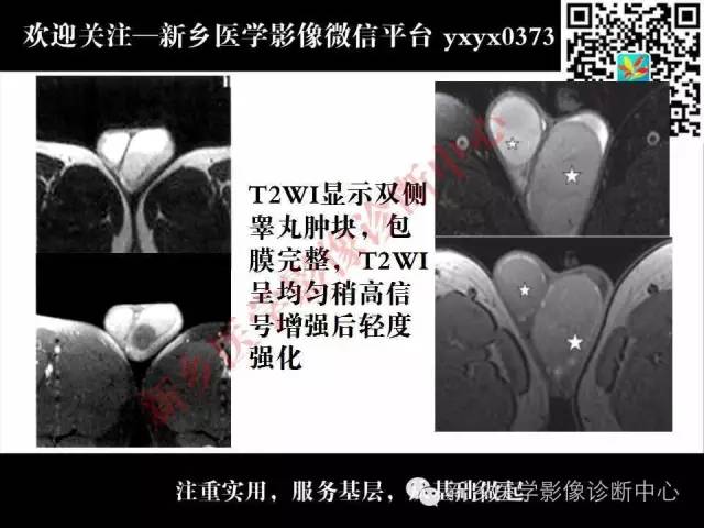 【PPT】睾丸肿瘤影像诊断