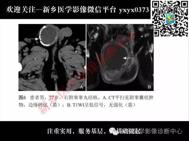 【PPT】睾丸肿瘤影像诊断