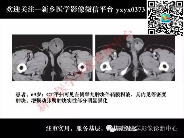 【PPT】睾丸肿瘤影像诊断