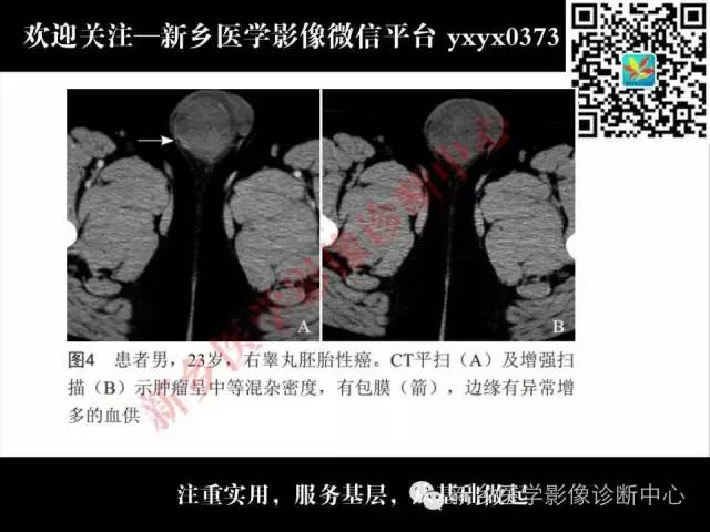 【PPT】睾丸肿瘤影像诊断