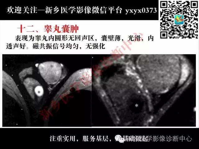【PPT】睾丸肿瘤影像诊断