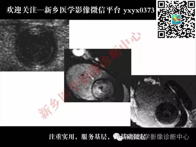 【PPT】睾丸肿瘤影像诊断