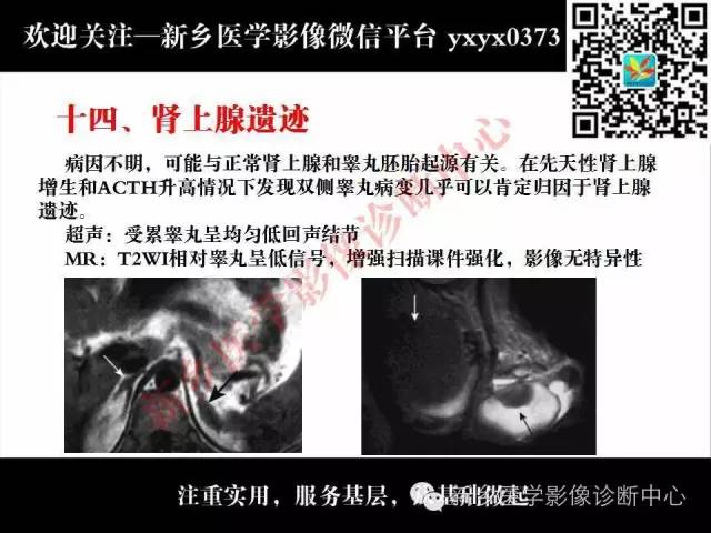 【PPT】睾丸肿瘤影像诊断