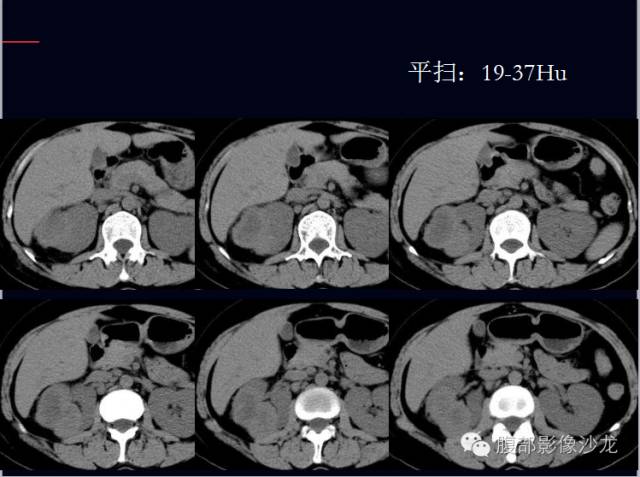 【病例】右肾集合管癌1例CT影像表现 【病例】右肾集合管癌1例CT影像表现