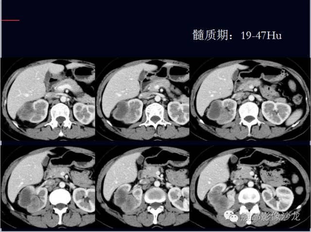 【病例】右肾集合管癌1例CT影像表现 【病例】右肾集合管癌1例CT影像表现