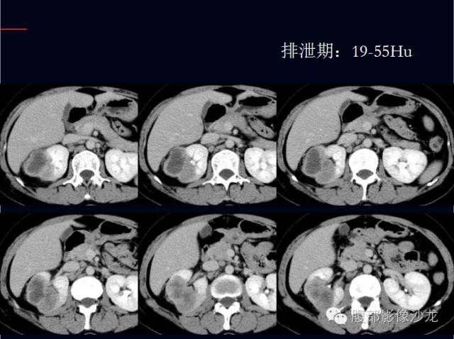 【病例】右肾集合管癌1例CT影像表现 【病例】右肾集合管癌1例CT影像表现