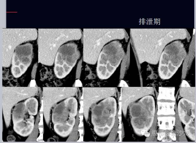 【病例】右肾集合管癌1例CT影像表现 【病例】右肾集合管癌1例CT影像表现