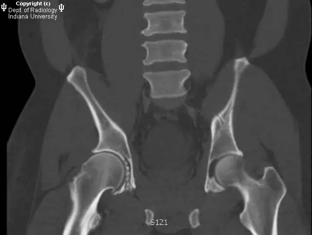 【病例】髋关节滑膜骨软骨瘤病1例X线及CT影像表现 【病例】髋关节滑膜骨软骨瘤病1例X线及CT影像表现