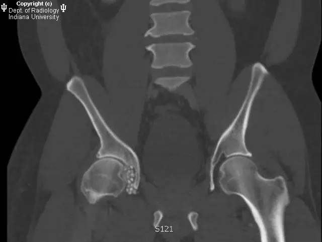 【病例】髋关节滑膜骨软骨瘤病1例X线及CT影像表现 【病例】髋关节滑膜骨软骨瘤病1例X线及CT影像表现