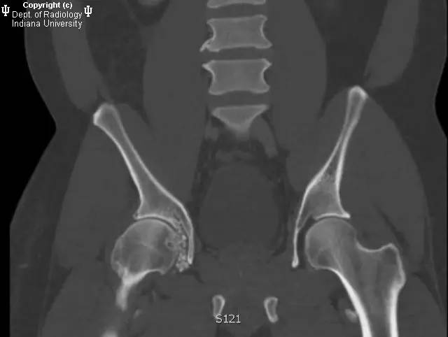 【病例】髋关节滑膜骨软骨瘤病1例X线及CT影像表现 【病例】髋关节滑膜骨软骨瘤病1例X线及CT影像表现