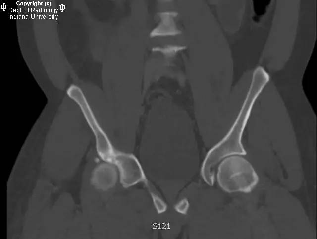 【病例】髋关节滑膜骨软骨瘤病1例X线及CT影像表现 【病例】髋关节滑膜骨软骨瘤病1例X线及CT影像表现