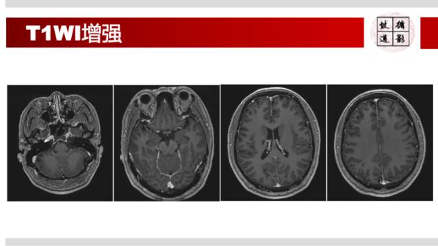 【病例】右侧烟雾综合征1例
