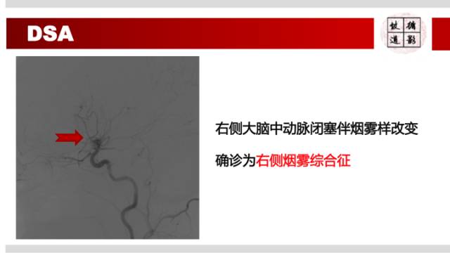 【病例】右侧烟雾综合征1例