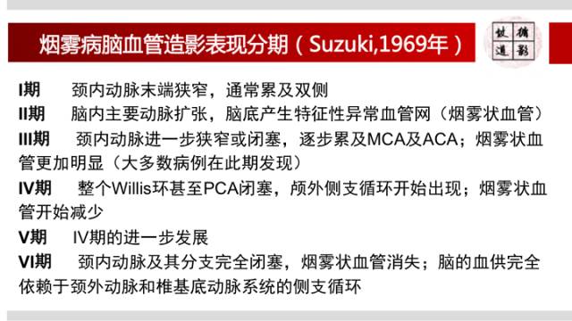 【病例】右侧烟雾综合征1例