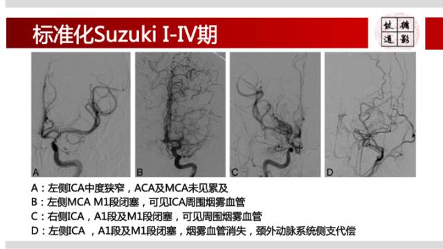 【病例】右侧烟雾综合征1例