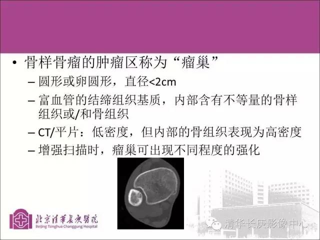 【PPT】骨样骨瘤的影像诊断
