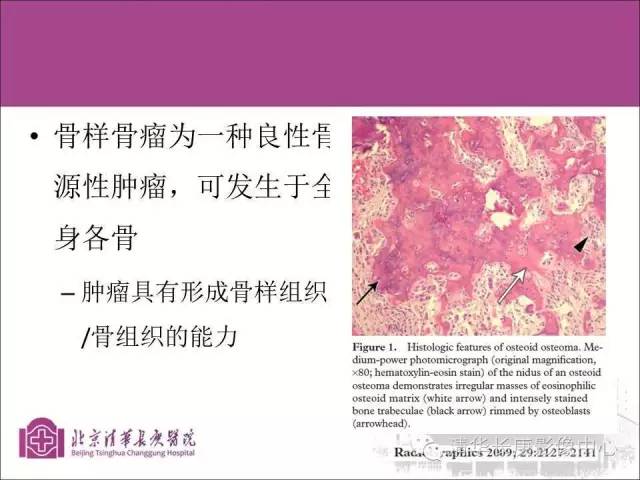 【PPT】骨样骨瘤的影像诊断