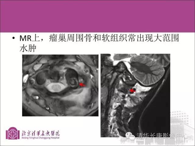 【PPT】骨样骨瘤的影像诊断
