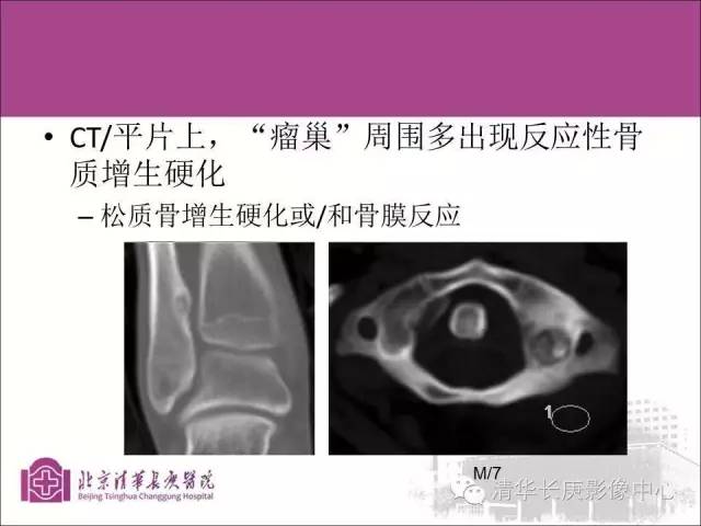 【PPT】骨样骨瘤的影像诊断