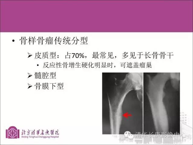 【PPT】骨样骨瘤的影像诊断