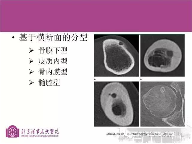 【PPT】骨样骨瘤的影像诊断