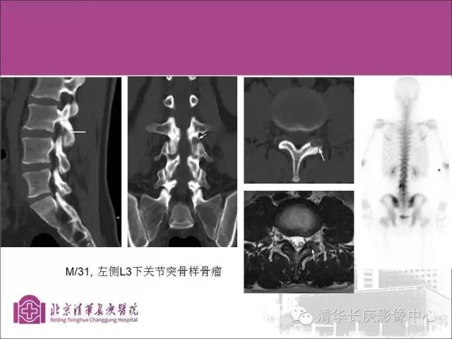 【PPT】骨样骨瘤的影像诊断