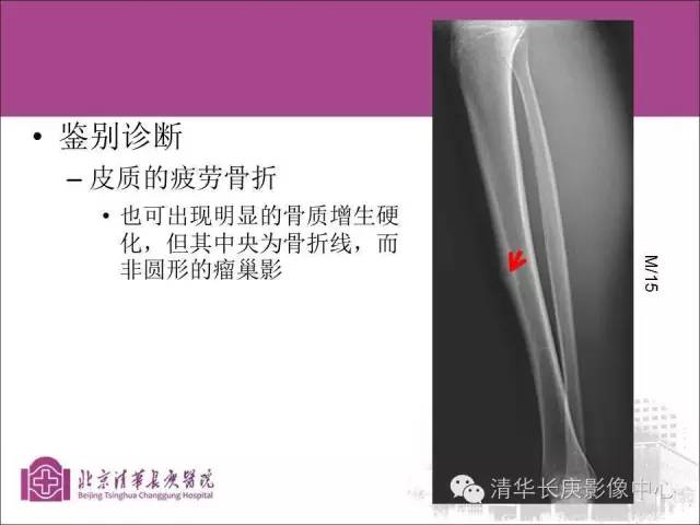 【PPT】骨样骨瘤的影像诊断