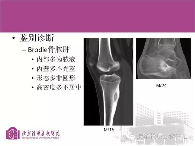 【PPT】骨样骨瘤的影像诊断