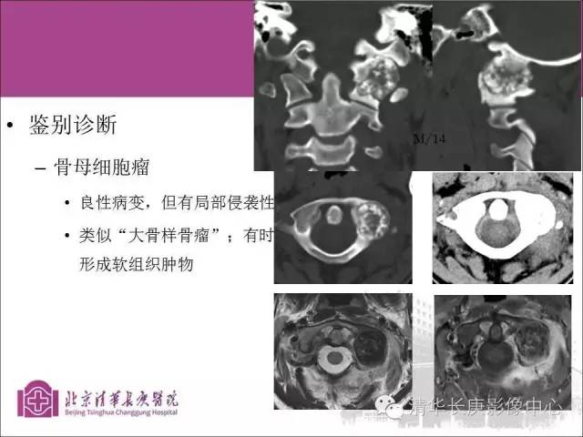 【PPT】骨样骨瘤的影像诊断