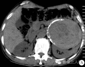 【病例】腹膜后恶性副神经节瘤伴肝转移1例CT