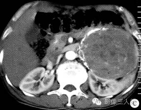 【病例】腹膜后恶性副神经节瘤伴肝转移1例CT 【病例】腹膜后恶性副神经节瘤伴肝转移1例CT