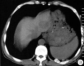 【病例】腹膜后恶性副神经节瘤伴肝转移1例CT 【病例】腹膜后恶性副神经节瘤伴肝转移1例CT