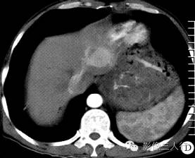 【病例】腹膜后恶性副神经节瘤伴肝转移1例CT 【病例】腹膜后恶性副神经节瘤伴肝转移1例CT