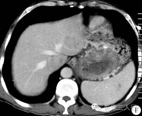 【病例】腹膜后恶性副神经节瘤伴肝转移1例CT 【病例】腹膜后恶性副神经节瘤伴肝转移1例CT