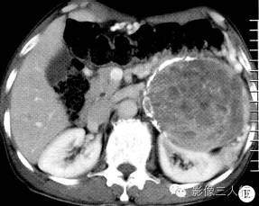 【病例】腹膜后恶性副神经节瘤伴肝转移1例CT 【病例】腹膜后恶性副神经节瘤伴肝转移1例CT