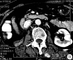 【病例】腹膜后恶性副神经节瘤伴肝转移1例CT 【病例】腹膜后恶性副神经节瘤伴肝转移1例CT