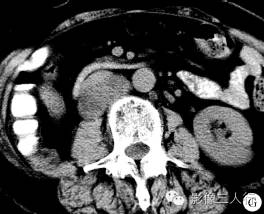 【病例】腹膜后恶性副神经节瘤伴肝转移1例CT 【病例】腹膜后恶性副神经节瘤伴肝转移1例CT
