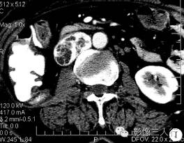 【病例】腹膜后恶性副神经节瘤伴肝转移1例CT 【病例】腹膜后恶性副神经节瘤伴肝转移1例CT