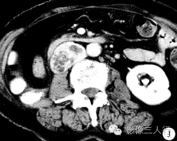 【病例】腹膜后恶性副神经节瘤伴肝转移1例CT 【病例】腹膜后恶性副神经节瘤伴肝转移1例CT