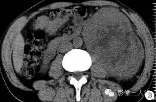 【病例】左肾纤维肉瘤1例CT影像表现 【病例】左肾纤维肉瘤1例CT影像表现