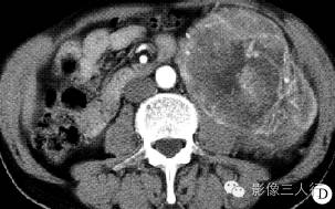 【病例】左肾纤维肉瘤1例CT影像表现 【病例】左肾纤维肉瘤1例CT影像表现