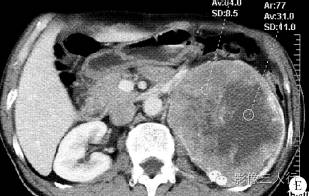 【病例】左肾纤维肉瘤1例CT影像表现 【病例】左肾纤维肉瘤1例CT影像表现
