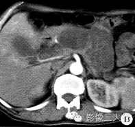 【病例】胰腺体尾部导管内乳头状黏液性囊腺癌1例CT及MR影像表现 【病例】胰腺体尾部导管内乳头状黏液性囊腺癌1例CT及MR影像表现