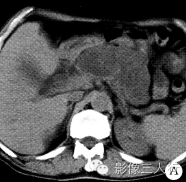 【病例】胰腺体尾部导管内乳头状黏液性囊腺癌1例CT及MR影像表现