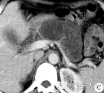 【病例】胰腺体尾部导管内乳头状黏液性囊腺癌1例CT及MR影像表现 【病例】胰腺体尾部导管内乳头状黏液性囊腺癌1例CT及MR影像表现