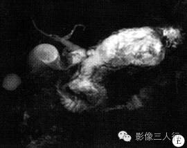 【病例】胰腺体尾部导管内乳头状黏液性囊腺癌1例CT及MR影像表现 【病例】胰腺体尾部导管内乳头状黏液性囊腺癌1例CT及MR影像表现